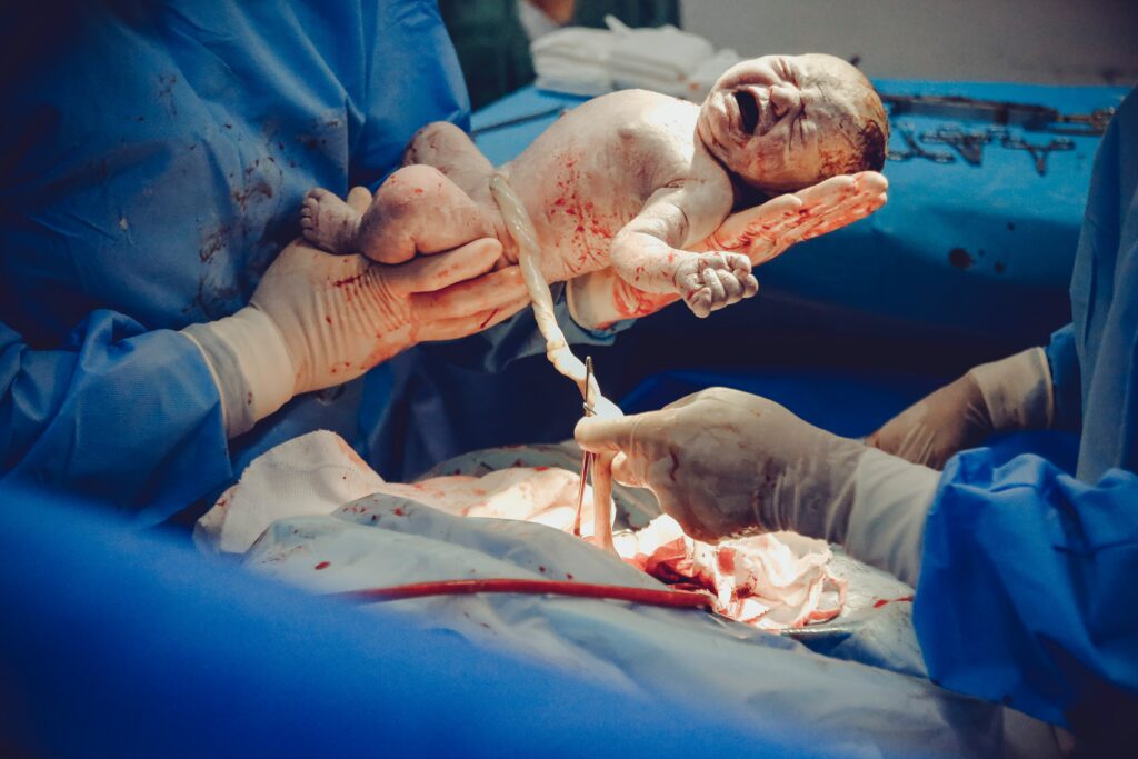 single umbilical artery